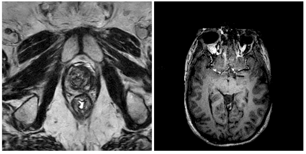 NVIDIA Releases Brain MRI Generation Model on Hugging Face: 3D Latent Diffusion for T1, FLAIR, T2, and SWI Scans